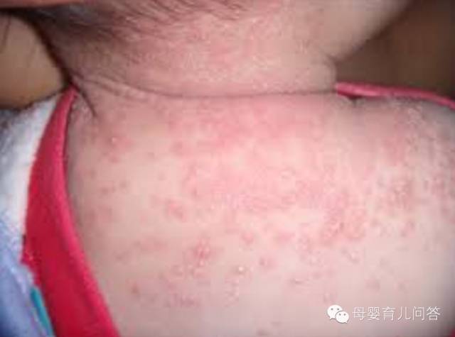 宝宝吃锌硒宝起疹子(锌硒片宝宝能吃吗)-硒宝网