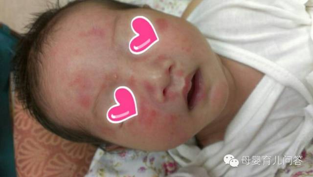 宝宝吃锌硒宝起疹子(锌硒片宝宝能吃吗)-硒宝网