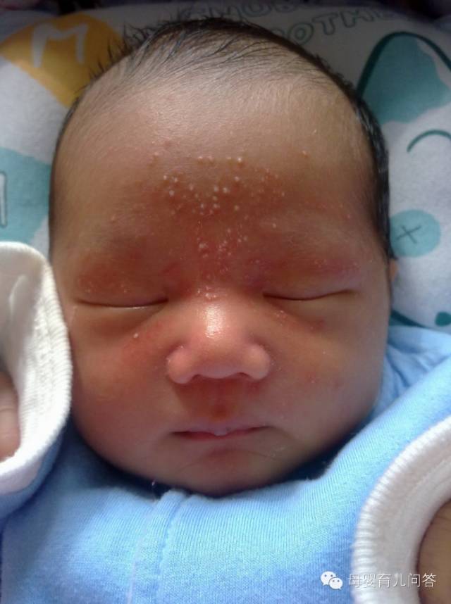 宝宝吃锌硒宝起疹子(锌硒片宝宝能吃吗)-硒宝网
