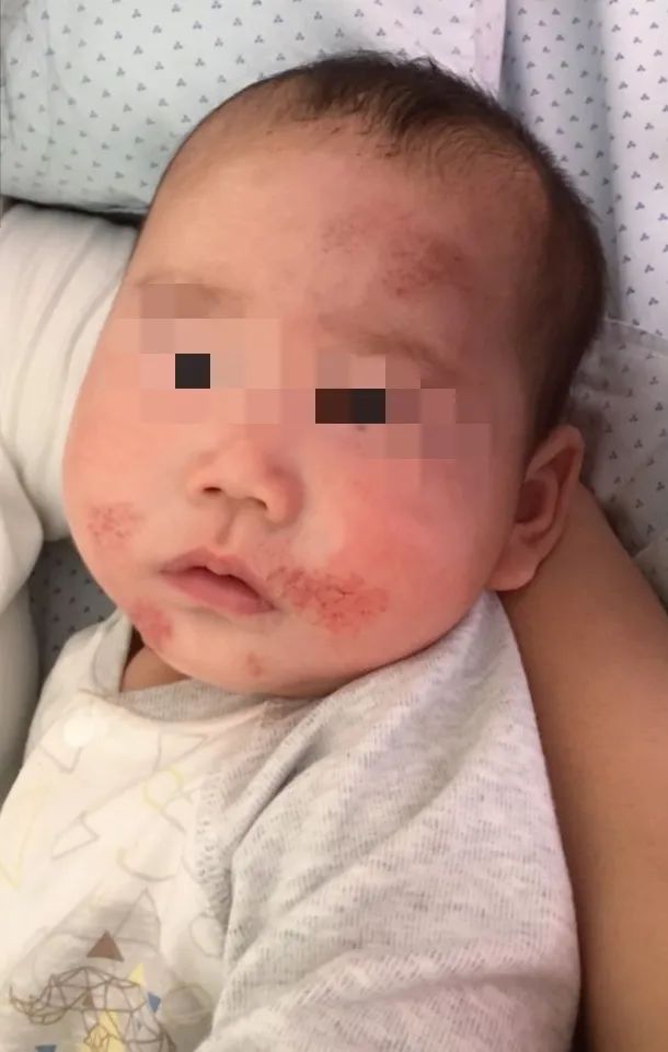 宝宝吃锌硒宝起疹子（锌硒宝宝宝吃了有什么效果）-硒宝网