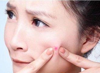 锌硒宝胶囊治疗痤疮(锌对痤疮)-硒宝网