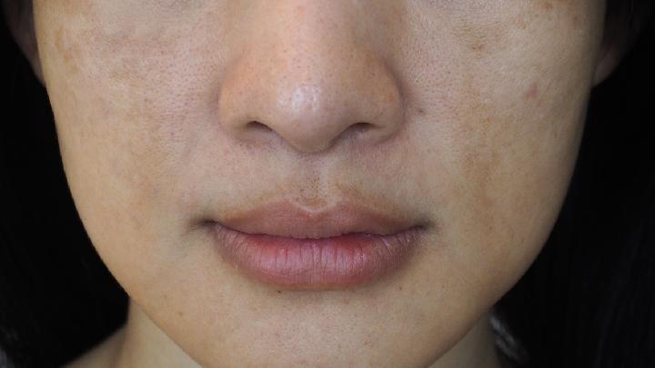 补锌能祛痘吗（祛痘补锌可以补多久）-硒宝网