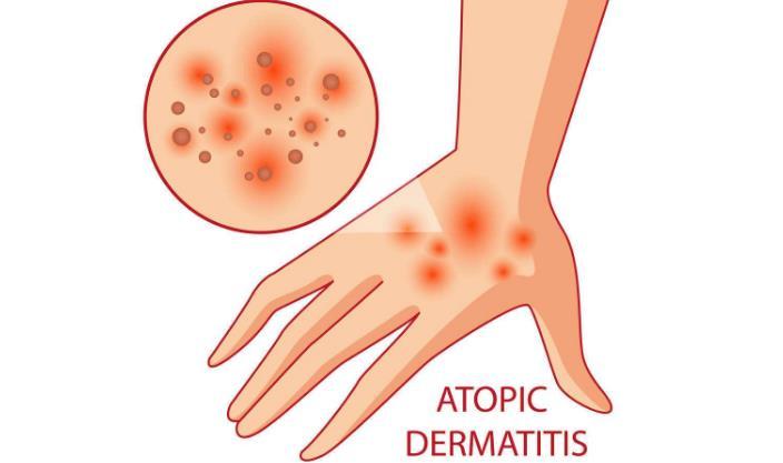 锌硒宝可以治湿疹吗（锌对湿疹的作用）-硒宝网