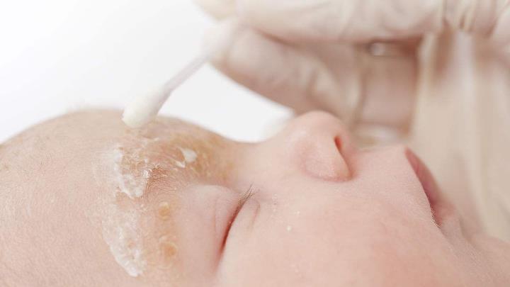 锌硒宝可以治湿疹吗（锌对湿疹的作用）-硒宝网