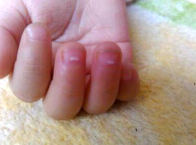 锌硒宝可以治湿疹吗（锌硒宝片能抵抗hpv吗）-硒宝网