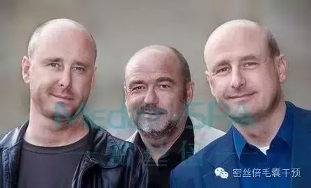 脱发缺什么微量元素（缺脱发微量元素有哪些）-硒宝网