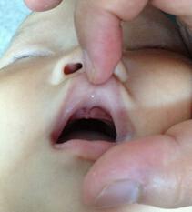 鹅口疮吃锌硒宝管吗（鹅口疮吃锌管用吗）-硒宝网