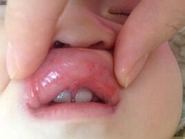 鹅口疮吃锌硒宝管吗（鹅口疮吃锌管用吗）-硒宝网