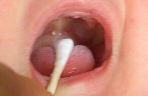 鹅口疮吃锌硒宝管吗（鹅口疮吃锌管用吗）-硒宝网