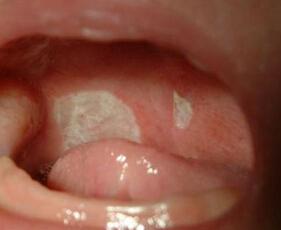 鹅口疮吃锌硒宝管吗(鹅口疮补锌)-硒宝网