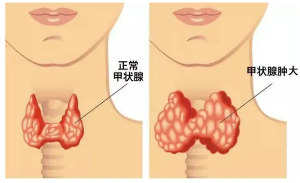 为什么甲状腺炎要补硒（甲状腺吃补硒的药）-硒宝网