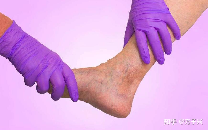 补硒能防治糖尿并发症(糖尿病人能补硒元素吗)-硒宝网