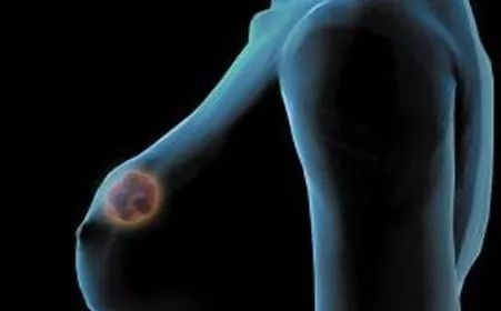 乳腺癌患者需要补硒吗(乳腺癌补硒一天用量是多少)-硒宝网