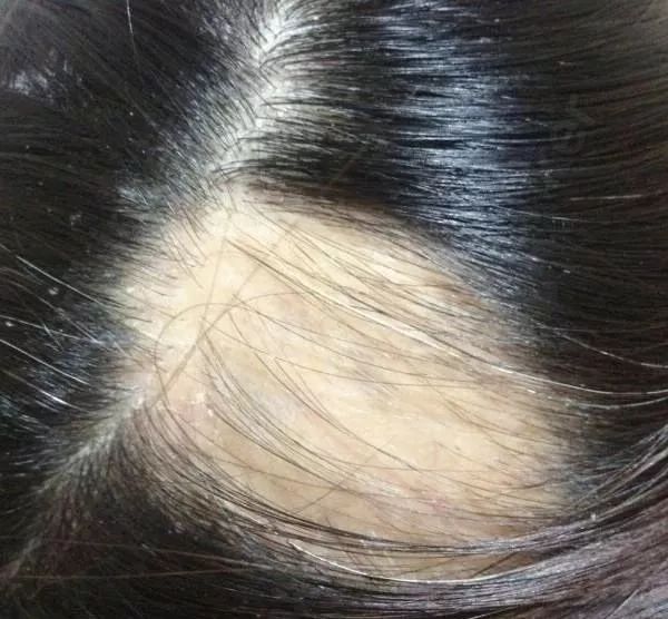 乳腺癌患者需要补硒吗(乳腺癌补硒一天用量是多少)-硒宝网