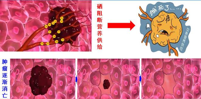肿瘤患者补硒有什么用(肿瘤补硒多少)-硒宝网