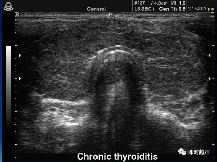 桥本氏甲状腺炎能补硒(桥本甲状腺炎补硒能降抗体吗)-硒宝网