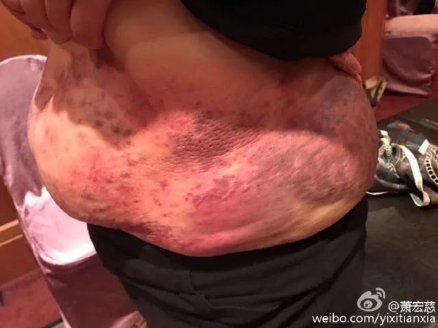 补硒可以治疗荨麻疹吗（荨麻疹可以吃补药吗）-硒宝网