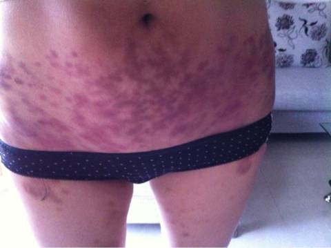 补硒可以治疗荨麻疹吗（荨麻疹可以吃补药吗）-硒宝网