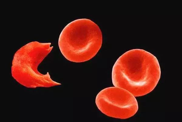 地贫能补铁吗（地贫患者补铁有什么后果）-硒宝网