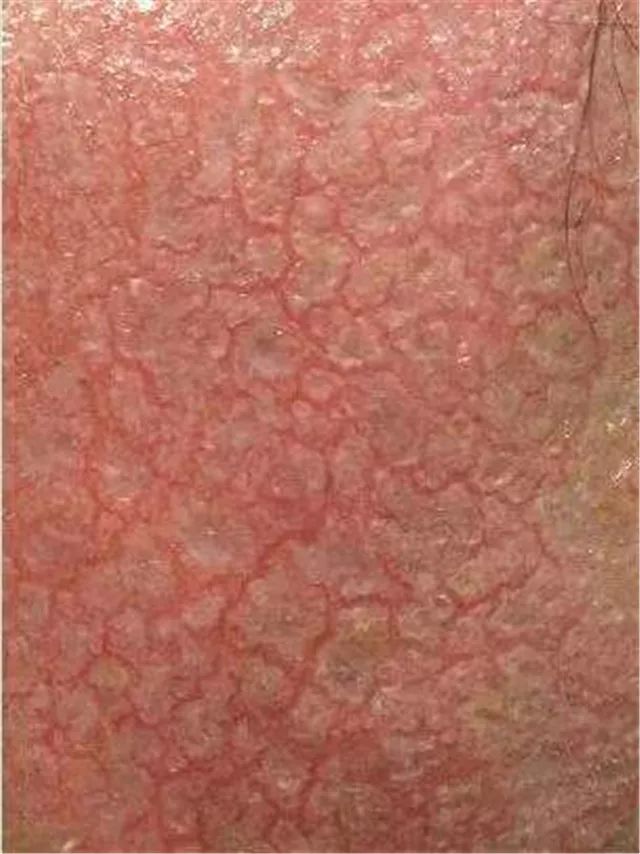 甲亢用不用补硒元素呢（用补元素甲亢硒片会怎样）-硒宝网