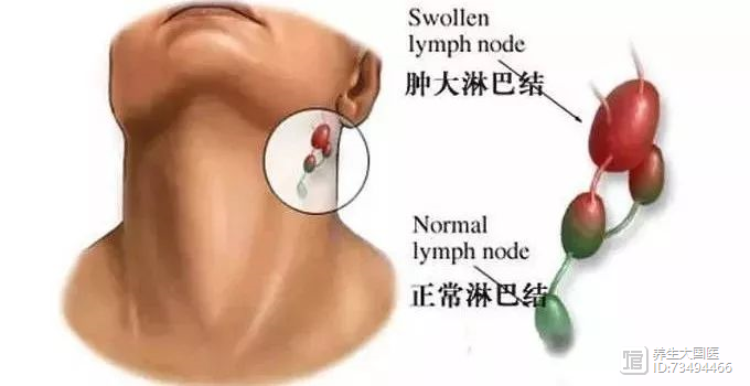淋巴瘤化疗后如何补硒(淋巴瘤化疗后能吃西洋参吗)-硒宝网