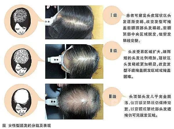 补硒掉头发严重吗女性(补硒头发)-硒宝网