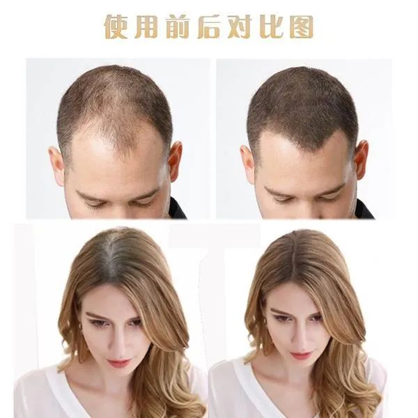 补硒掉头发严重吗女性(补硒头发)-硒宝网