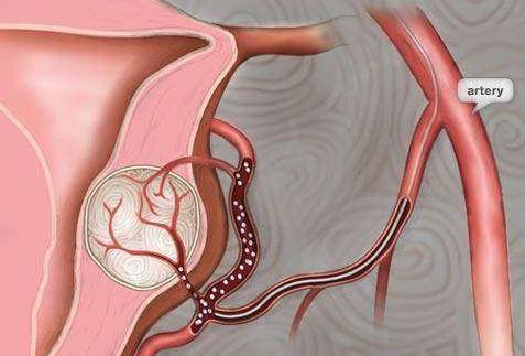 补硒会引起子宫肌瘤吗(补充硒元素子宫肌瘤会长大吗)-硒宝网