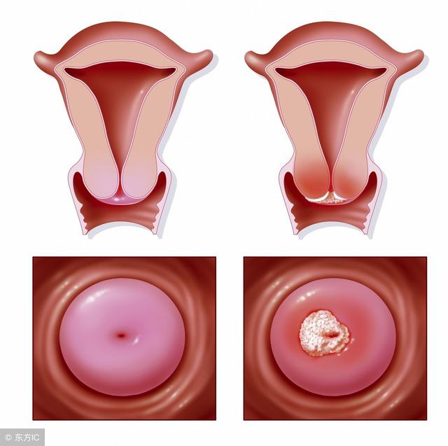 得了宫颈癌可以补硒嘛（宫颈癌患者可以补硒吗）-硒宝网