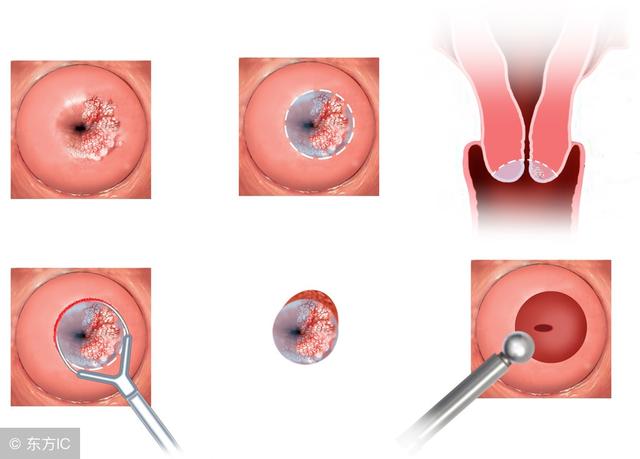 得了宫颈癌可以补硒嘛（宫颈癌患者可以补硒吗）-硒宝网