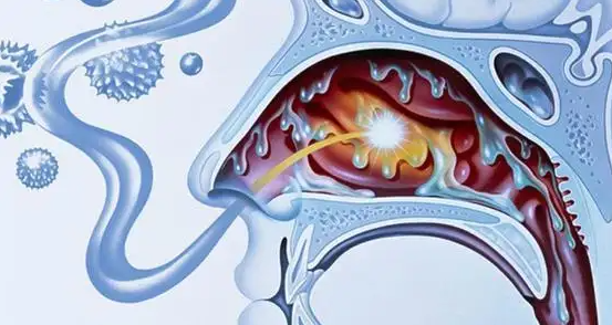 补硒可改善过敏性鼻炎(硒对过敏性湿疹的功效)-硒宝网