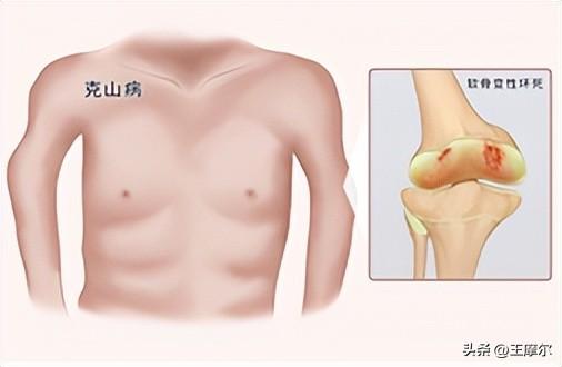 艾滋病患者需要补硒吗(艾滋病人要补硒吗)-硒宝网