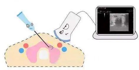 甲癌术后为什么要补硒(甲癌术后能吃硒酵母吗)-硒宝网