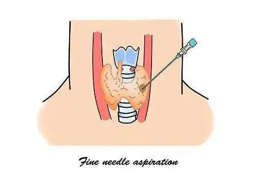 甲癌术后为什么要补硒(甲癌术后能吃硒酵母吗)-硒宝网