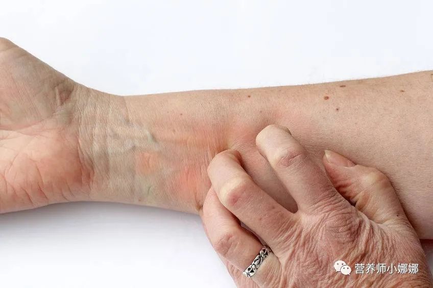 脂溢性皮炎补硒有用吗（硒酵母片脂溢性皮炎）-硒宝网