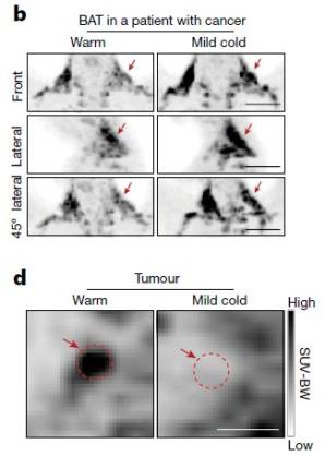 给癌症病人补硒可以吗（癌症能补硒）-硒宝网