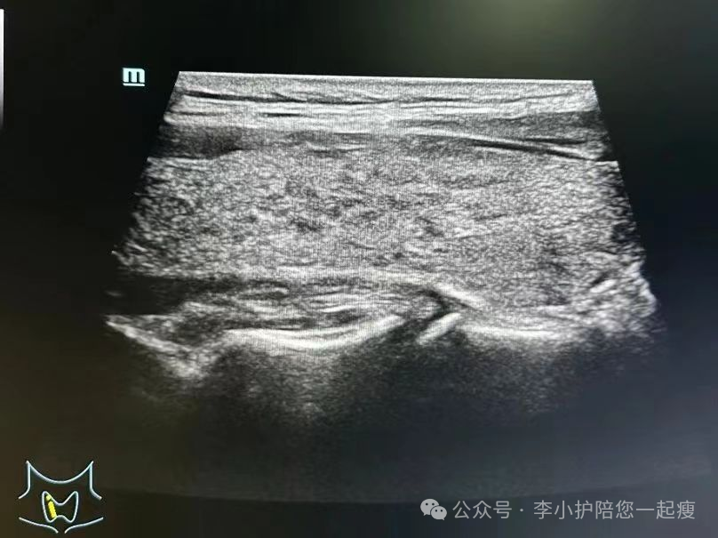 桥本甲减一天补硒多少（补硒对桥本氏甲状腺炎有用吗）-硒宝网