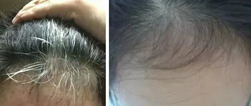 孩子有白头发是缺少什么微量元素(少白头不缺微量元素)-硒宝网