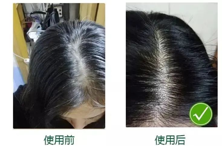 孩子有白头发是缺少什么微量元素(少白头不缺微量元素)-硒宝网