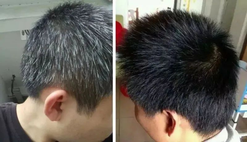 孩子有白头发是缺少什么微量元素(少白头不缺微量元素)-硒宝网