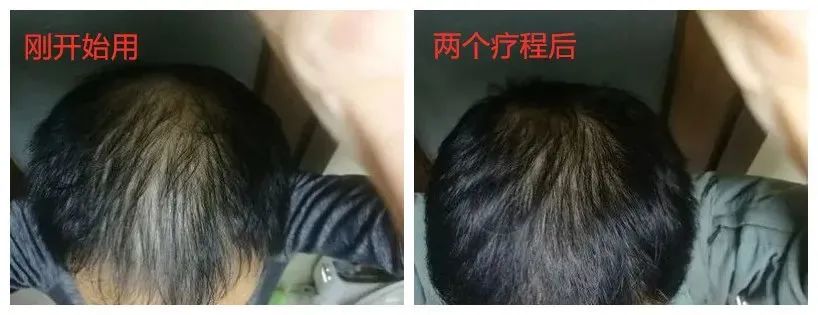 孩子有白头发是缺少什么微量元素(少白头不缺微量元素)-硒宝网