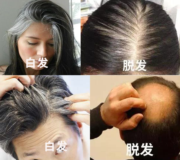 孩子有白头发是缺少什么微量元素(少白头不缺微量元素)-硒宝网