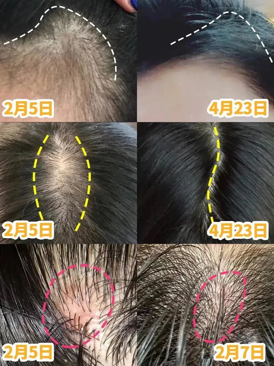 孩子有白头发是缺少什么微量元素(少白头不缺微量元素)-硒宝网