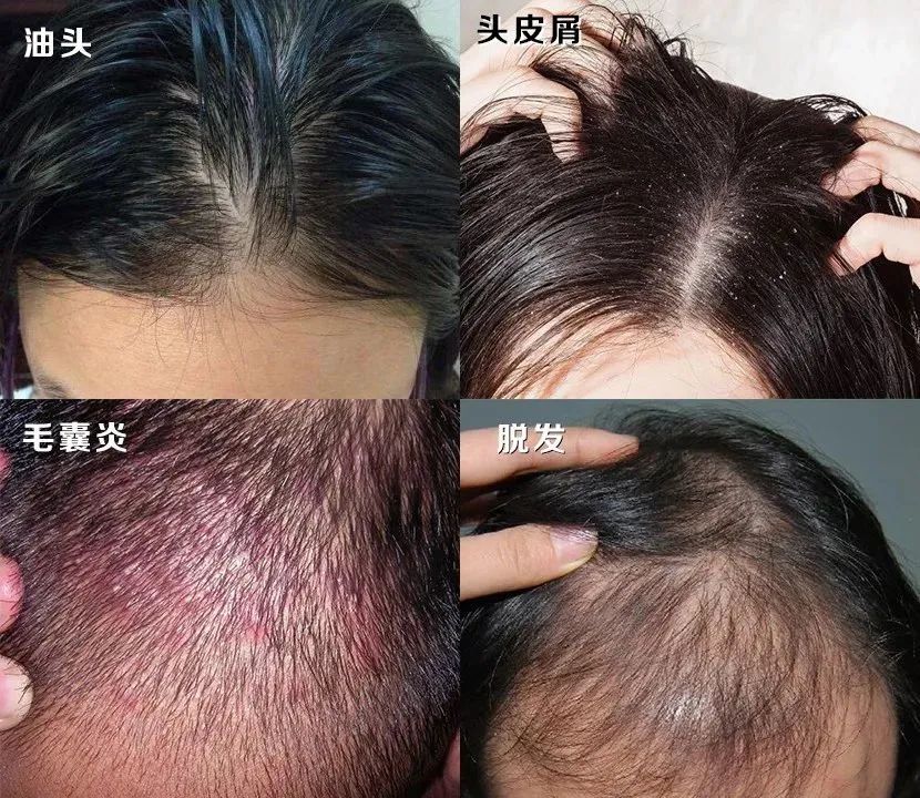 孩子有白头发是缺少什么微量元素(少白头不缺微量元素)-硒宝网