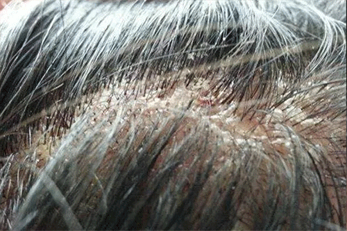 孩子有白头发是缺少什么微量元素(少白头不缺微量元素)-硒宝网