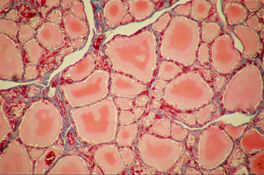 甲状腺肿大可以补硒嘛(甲状腺肿大可以吃硒片吗)-硒宝网