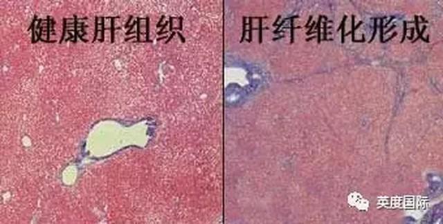 药物性肝损能不能补硒(肝病患者补硒)-硒宝网