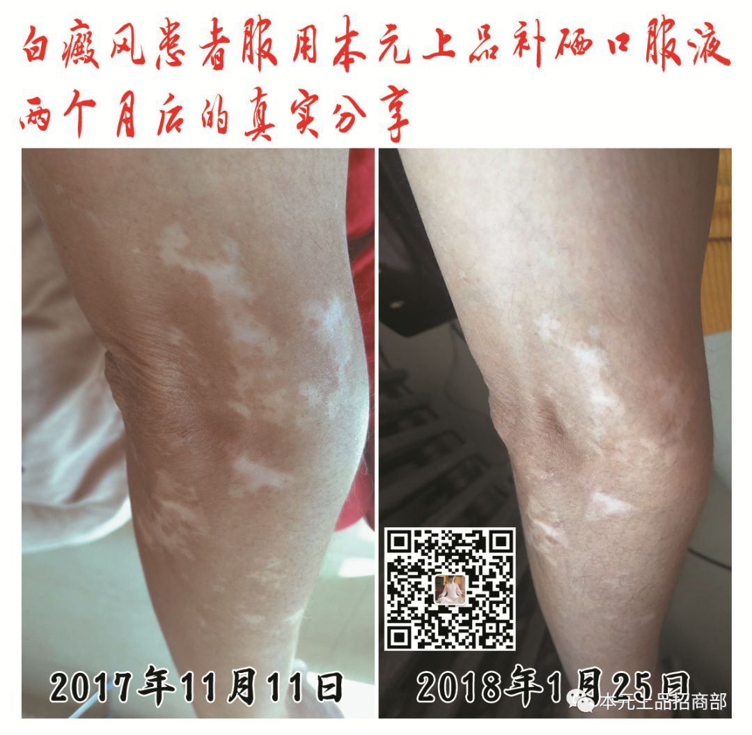 心脑血管病人补硒标准（硒对心脑血管疾病的作用）-硒宝网