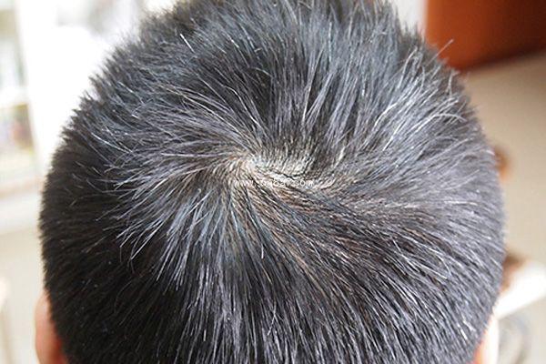 孩子有白头发是缺少什么微量元素(微量元素缺乏引起白头发)-硒宝网