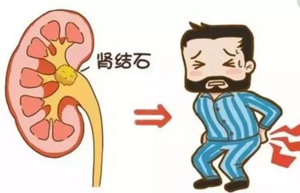 肾结石能吃钙片补钙吗（肾能结石补钙吃钙片有效果吗）-硒宝网